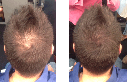 Disimular alopecia con Fibras capilares para hombres  NANOGEN