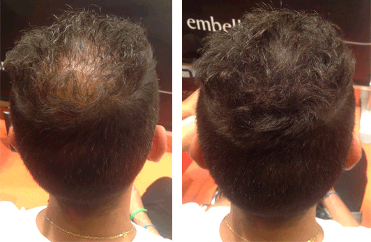 Disimular alopecia con Fibras capilares para hombres  NANOGEN