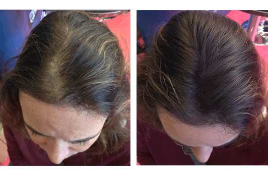 Peinados para disimular la calvicie femenina  5 pasos