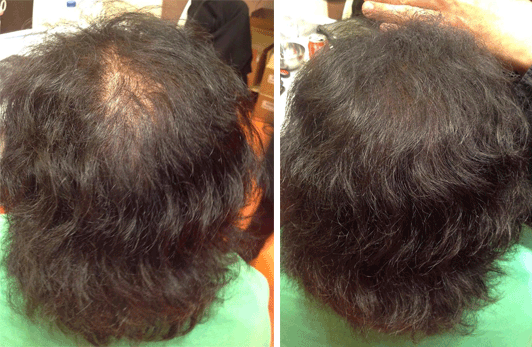 Disimular alopecia con Fibras capilares para mujeres  NANOGEN